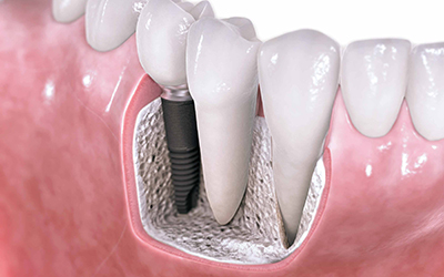 Dental Implants