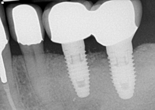 implant crown 3