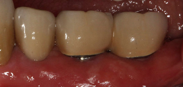 implant crown 4