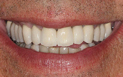 Veneers